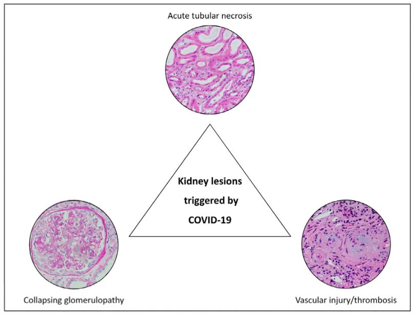 Fig 1. Pathologic findings in COVID-19 associated acute kidney injury. Fig 1. Pathologic findings in COVID-19 associated acute kidney injury.