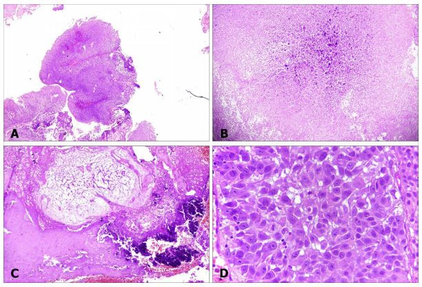 Figure 1: Tumor in urinary bladder. Photomicrographs of tumour in urinary bladder, showing noninvasive papillary urothelial  carcinoma (A, 4x), area of necrosis (B, 10x), focus of calcification (C, 10x), and tumour (D, 40x)