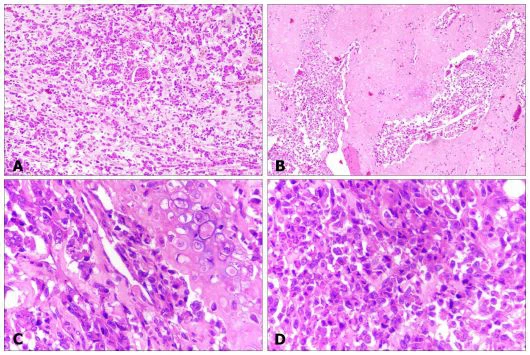 Figure 3: Tumor in kidney. Photomicrographs of tumour in kidney, showing tumour (A, 10x), areas of cartilaginous differentiation (B and C, 10x and 40x), and high mitotic activity (D, 40x).