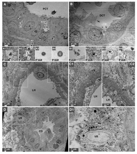 Figure 3. Ultrastructural localization of mineral NPs in diseased human kidney tissues. (A–D)