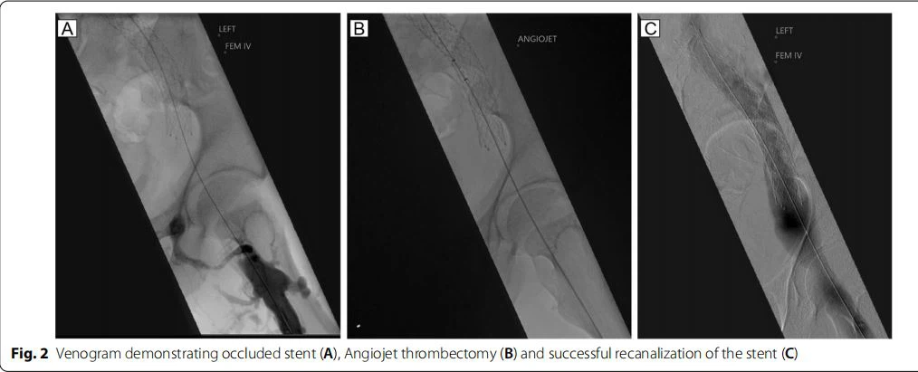 Venogram demonstrating occluded stent (A), Angiojet thrombectomy (B) and successful recanalization of the stent (C)