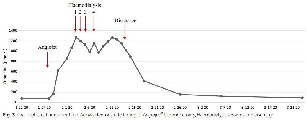 Graph of Creatinine over time. Arrows demonstrate timing of Angiojet® thrombectomy, Haemodialysis sessions and discharge