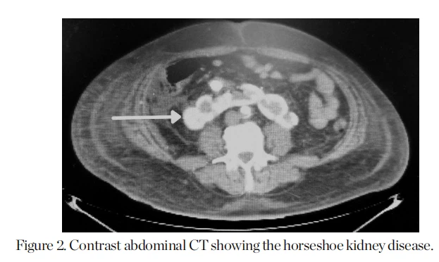  Contrast abdominal CT showing the horseshoe kidney disease.